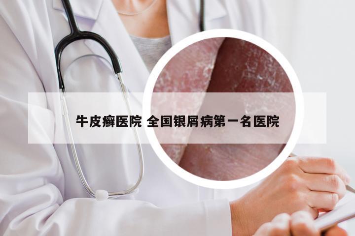 牛皮癣医院 全国银屑病第一名医院