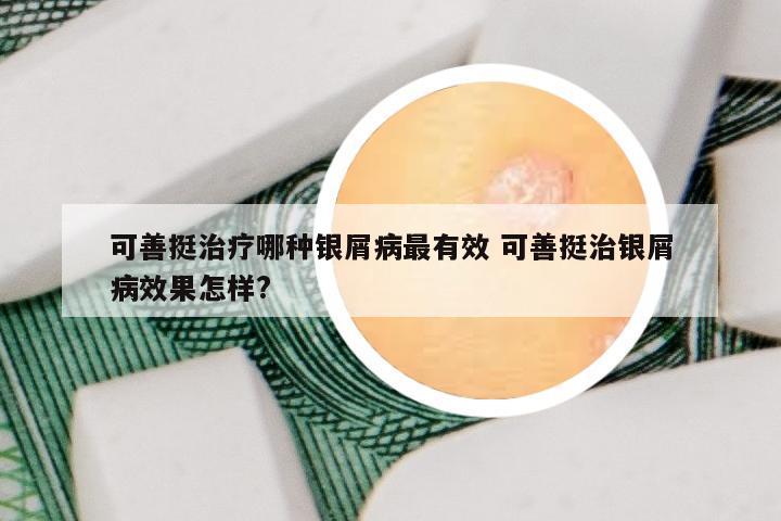 可善挺治疗哪种银屑病最有效 可善挺治银屑病效果怎样?