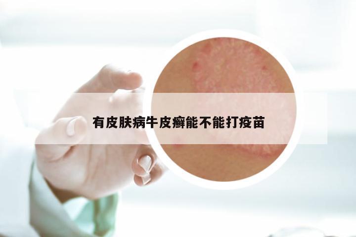有皮肤病牛皮癣能不能打疫苗