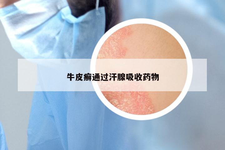 牛皮癣通过汗腺吸收药物