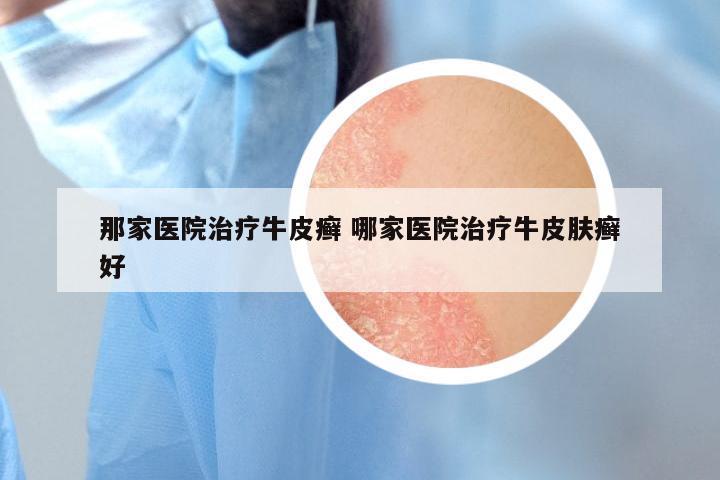 那家医院治疗牛皮癣 哪家医院治疗牛皮肤癣好