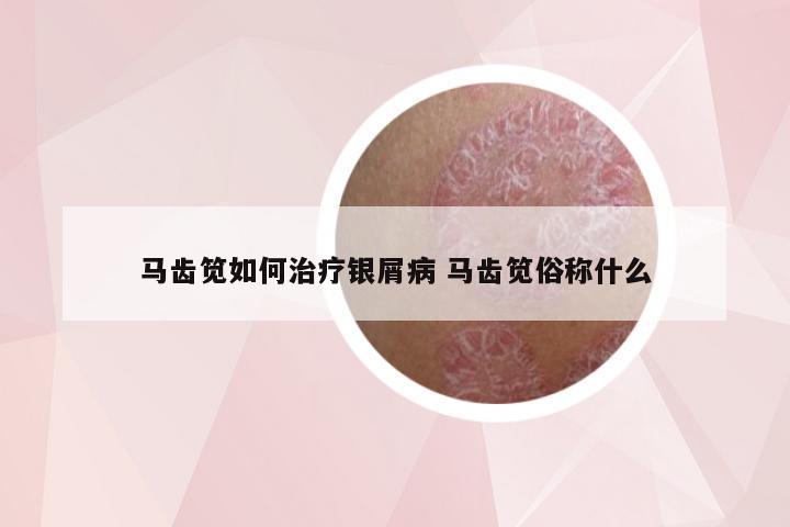马齿笕如何治疗银屑病 马齿笕俗称什么