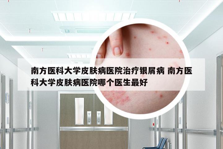 南方医科大学皮肤病医院治疗银屑病 南方医科大学皮肤病医院哪个医生最好