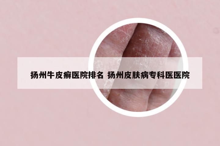 扬州牛皮癣医院排名 扬州皮肤病专科医医院