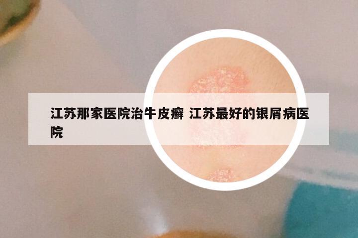 江苏那家医院治牛皮癣 江苏最好的银屑病医院