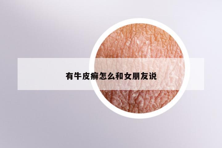 有牛皮癣怎么和女朋友说