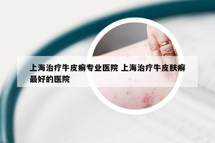 上海治疗牛皮癣专业医院 上海治疗牛皮肤癣最好的医院