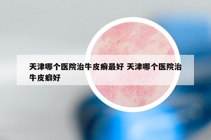天津哪个医院治牛皮癣最好 天津哪个医院治牛皮癖好