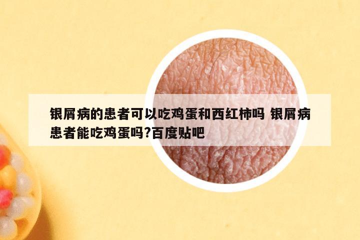 银屑病的患者可以吃鸡蛋和西红柿吗 银屑病患者能吃鸡蛋吗?百度贴吧
