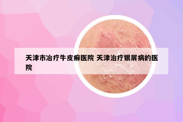 天津市冶疗牛皮癣医院 天津治疗银屑病的医院