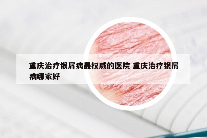 重庆治疗银屑病最权威的医院 重庆治疗银屑病哪家好