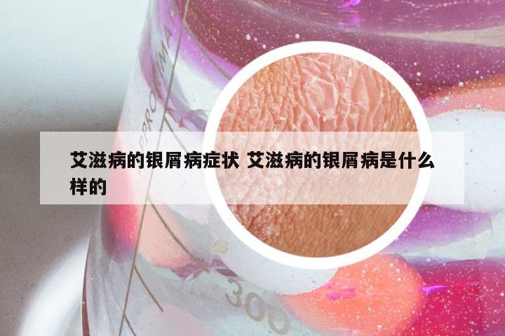艾滋病的银屑病症状 艾滋病的银屑病是什么样的