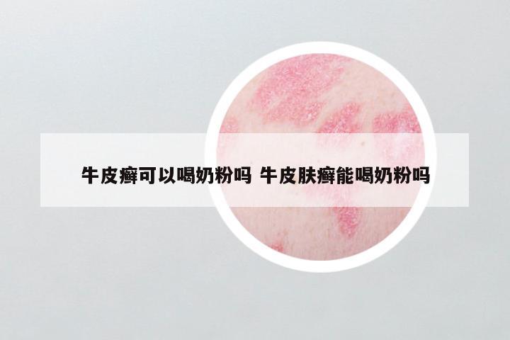牛皮癣可以喝奶粉吗 牛皮肤癣能喝奶粉吗