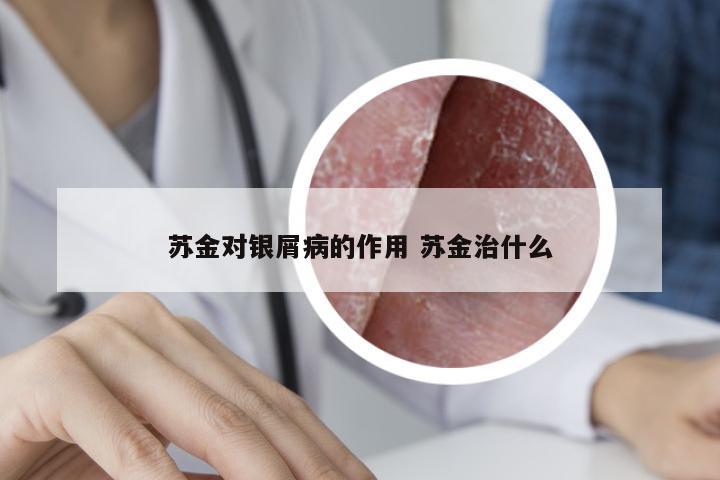 苏金对银屑病的作用 苏金治什么