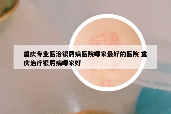 重庆专业医治银屑病医院哪家最好的医院 重庆治疗银屑病哪家好