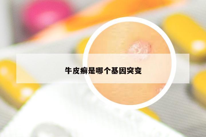 牛皮癣是哪个基因突变