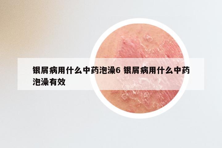 银屑病用什么中药泡澡6 银屑病用什么中药泡澡有效