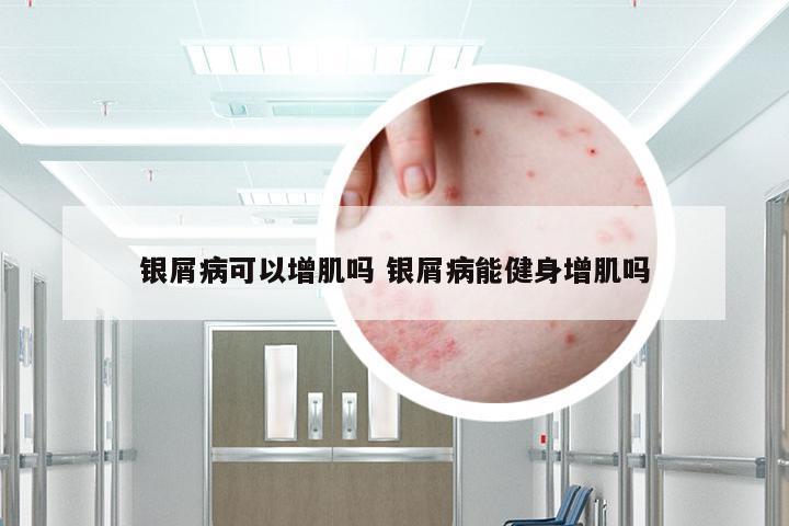 银屑病可以增肌吗 银屑病能健身增肌吗