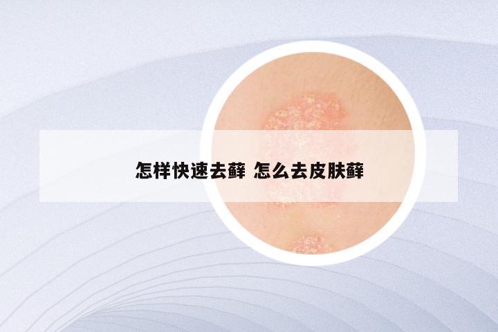 怎样快速去藓 怎么去皮肤藓