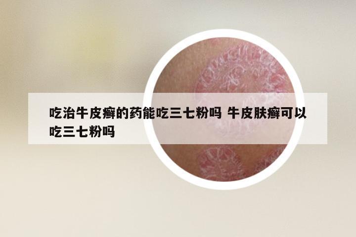吃治牛皮癣的药能吃三七粉吗 牛皮肤癣可以吃三七粉吗