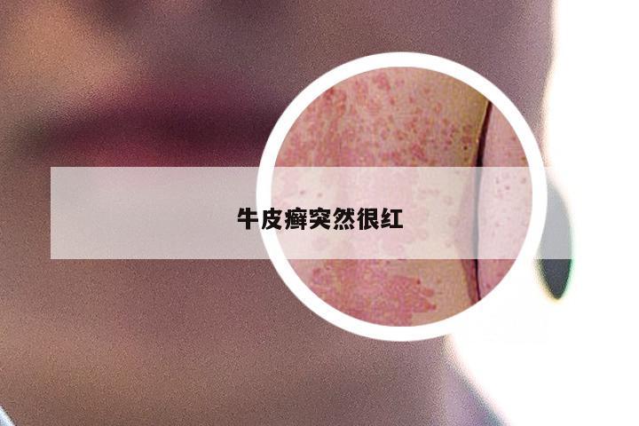 牛皮癣突然很红