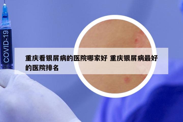 重庆看银屑病的医院哪家好 重庆银屑病最好的医院排名