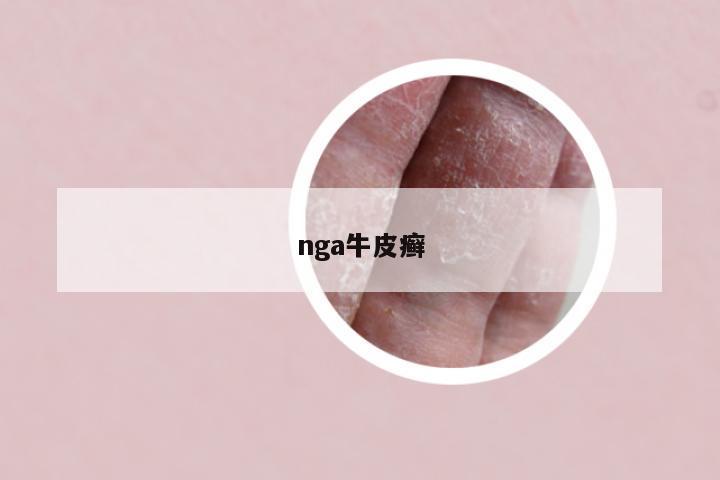 nga牛皮癣