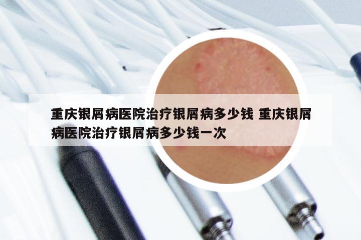 重庆银屑病医院治疗银屑病多少钱 重庆银屑病医院治疗银屑病多少钱一次