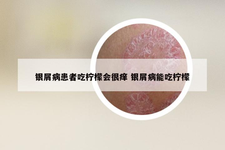 银屑病患者吃柠檬会很痒 银屑病能吃柠檬