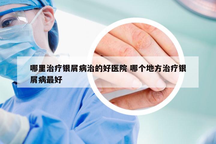 哪里治疗银屑病治的好医院 哪个地方治疗银屑病最好