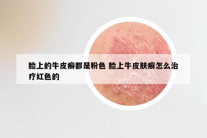 脸上的牛皮癣都是粉色 脸上牛皮肤癣怎么治疗红色的