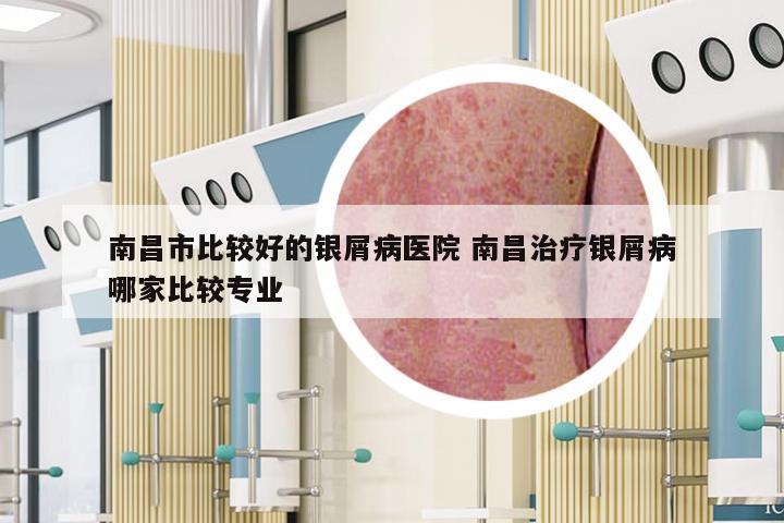 南昌市比较好的银屑病医院 南昌治疗银屑病哪家比较专业