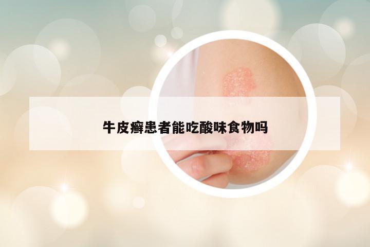 牛皮癣患者能吃酸味食物吗