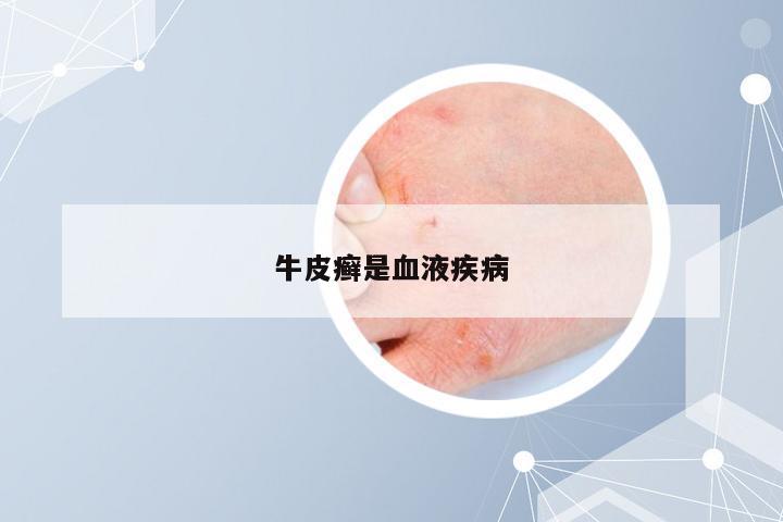 牛皮癣是血液疾病