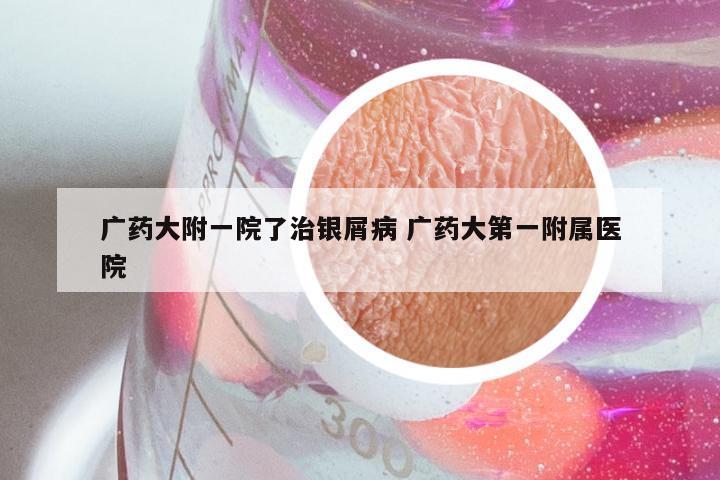 广药大附一院了治银屑病 广药大第一附属医院