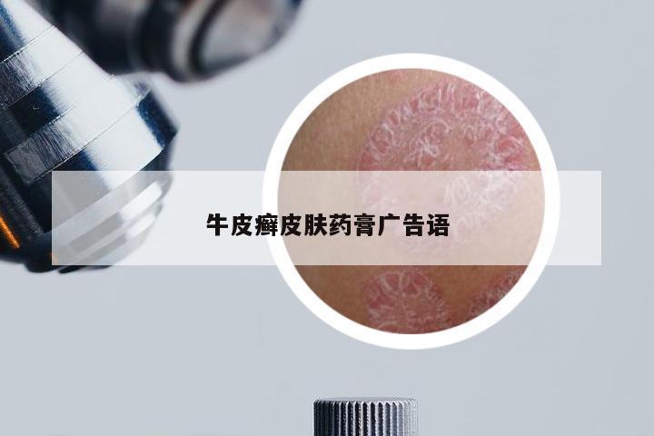 牛皮癣皮肤药膏广告语