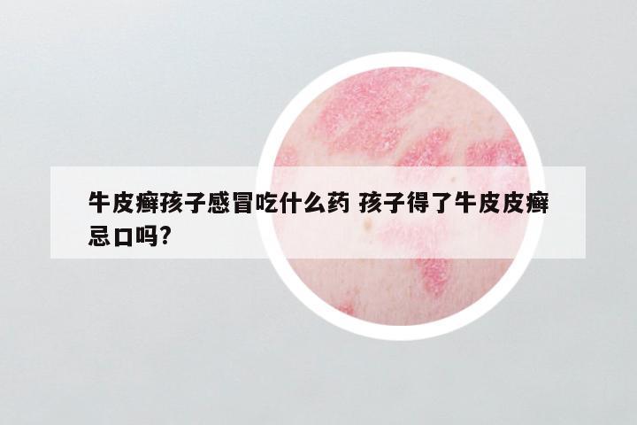 牛皮癣孩子感冒吃什么药 孩子得了牛皮皮癣忌口吗?