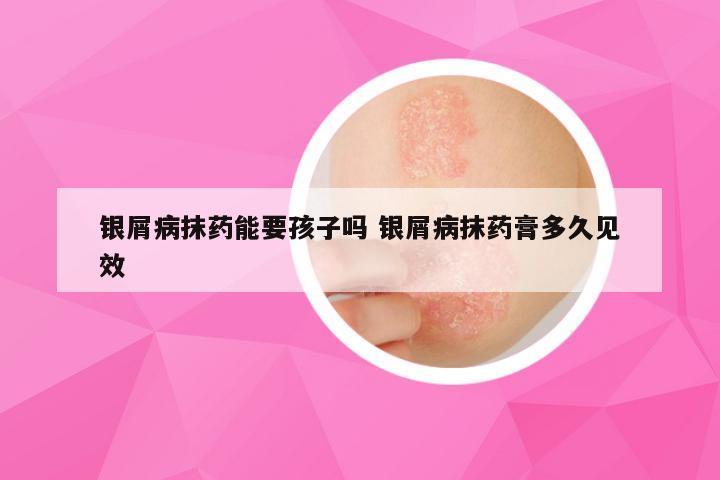 银屑病抹药能要孩子吗 银屑病抹药膏多久见效