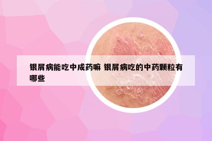 银屑病能吃中成药嘛 银屑病吃的中药颗粒有哪些