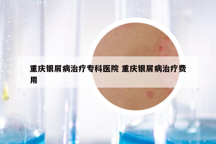 重庆银屑病治疗专科医院 重庆银屑病治疗费用