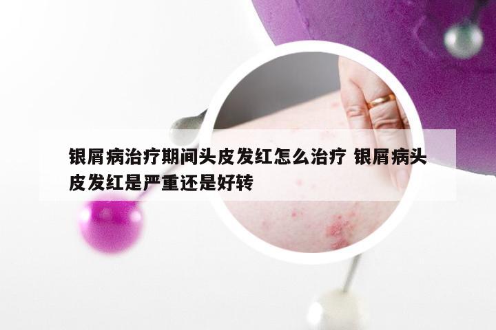 银屑病治疗期间头皮发红怎么治疗 银屑病头皮发红是严重还是好转