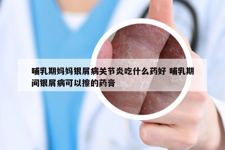 哺乳期妈妈银屑病关节炎吃什么药好 哺乳期间银屑病可以擦的药膏