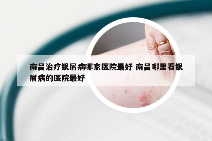 南昌治疗银屑病哪家医院最好 南昌哪里看银屑病的医院最好