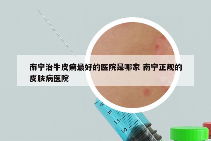 南宁治牛皮癣最好的医院是哪家 南宁正规的皮肤病医院
