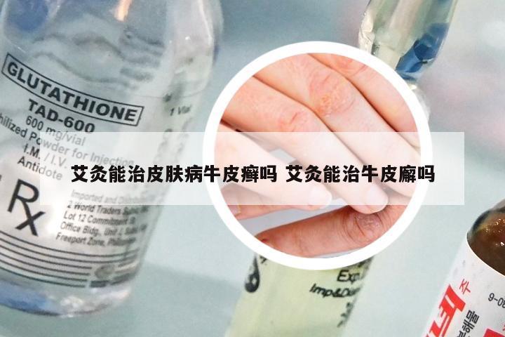 艾灸能治皮肤病牛皮癣吗 艾灸能治牛皮廨吗