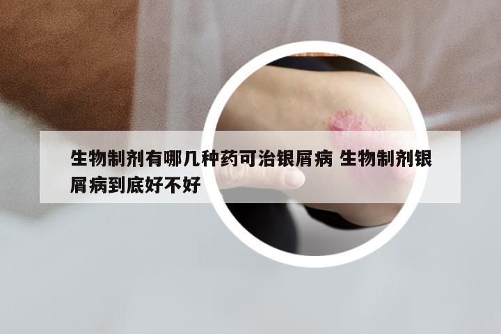 生物制剂有哪几种药可治银屑病 生物制剂银屑病到底好不好