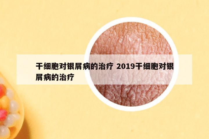 干细胞对银屑病的治疗 2019干细胞对银屑病的治疗