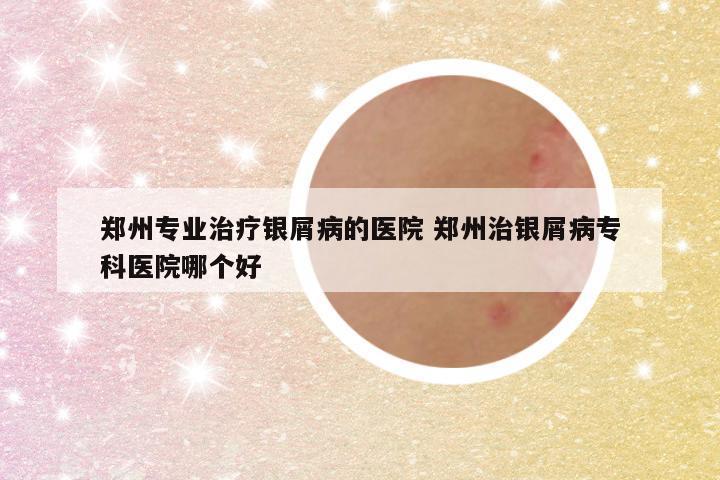 郑州专业治疗银屑病的医院 郑州治银屑病专科医院哪个好