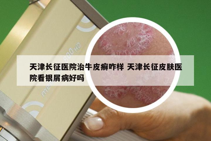 天津长征医院治牛皮癣咋样 天津长征皮肤医院看银屑病好吗