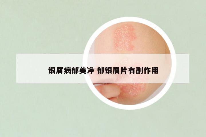 银屑病郁美净 郁银屑片有副作用